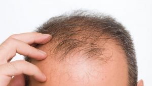 Рей Пийт , косопад, xenobg, хормонален дисбаланс